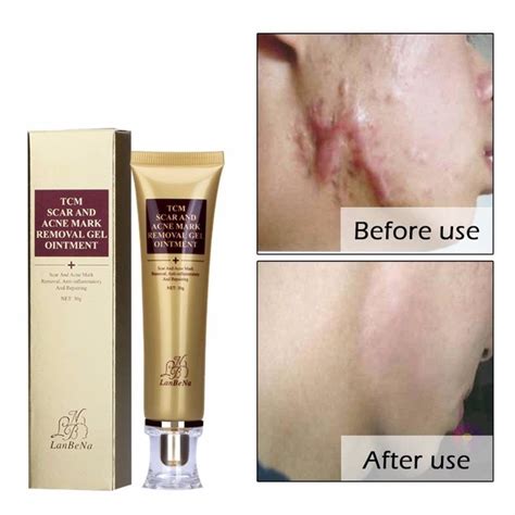 TCM SCAR AND ACNE MARK REMOVAL GEL OINTMENT (30g) Acne Scar Cream