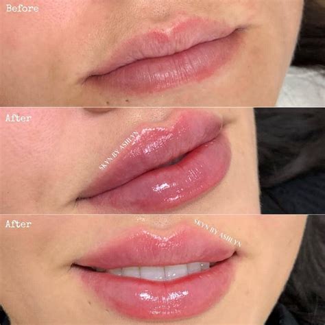 Best of Cosmetic Dermatology on Instagram: “Before/after lip filler Details below. ... | Botox ...