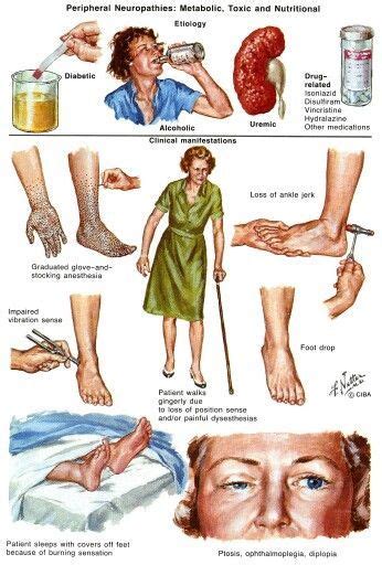 8 Peripheral Neuropathy,Idiopathic Neuropathy ideas | neuropathy ...