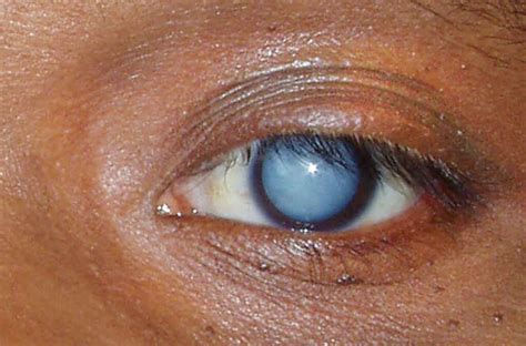 Common Eye Diseases Vision Loss Resources - vrogue.co