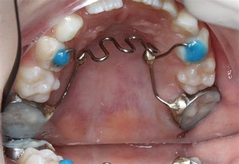 What is a Tongue thrust Habit? Align Dentistry Blog Call (02) 9723 5757