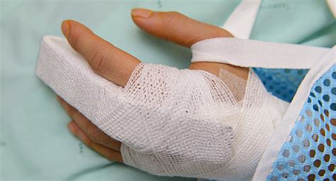 Symptoms of a Fractured FInger | Northwest Broward Orthopaedics