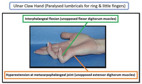 Claw hand causes, signs, symptoms, diagnosis and claw hand treatment