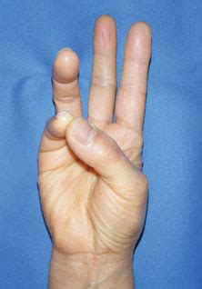 More than half of patients regain thumb opposition after carpal tunnel ...