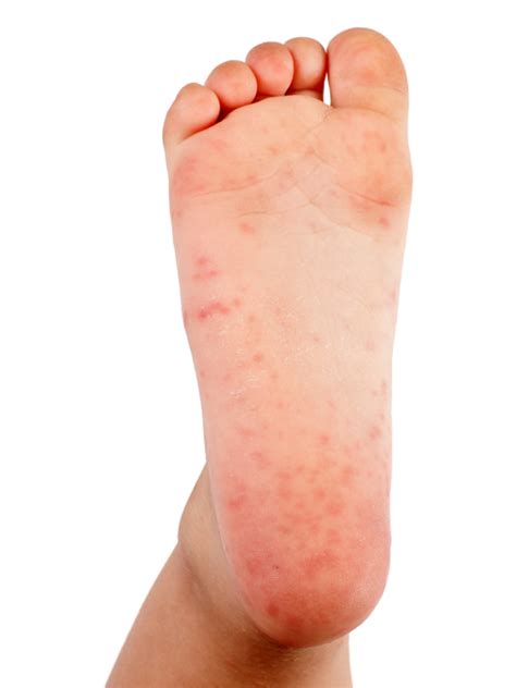 It’s Not Strep Throat: Treating Hand, Foot, and Mouth Disease | University of Utah Health