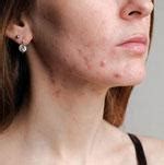 Acne: how to improve it – Labo SVR US