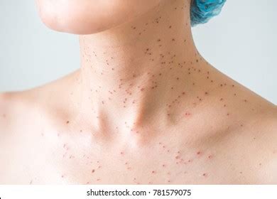 432 Skin Burn Laser Treatment Images, Stock Photos & Vectors | Shutterstock