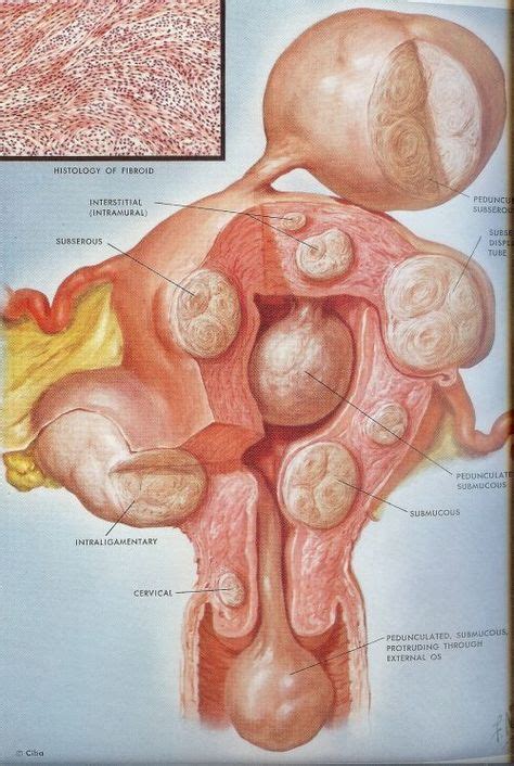 Uterus Fibroid Size Chart