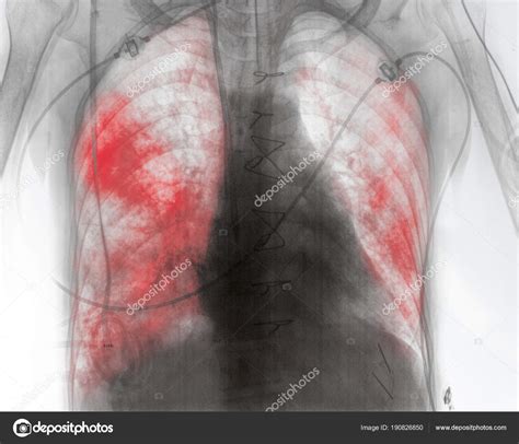 X-ray image of patient with lung inflammation in the early post- Stock ...