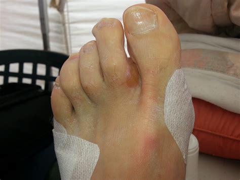 Distal Forefoot Blisters: A Confusing Blister Location - Blister Prevention