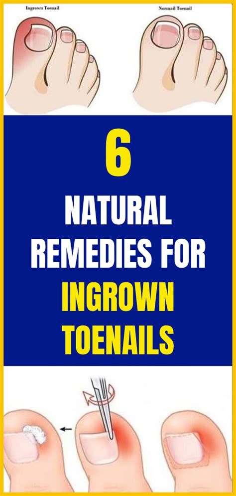 6 Natural Remedies For Ingrown Toenails