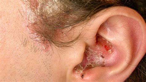 Plaque Psoriasis Ear