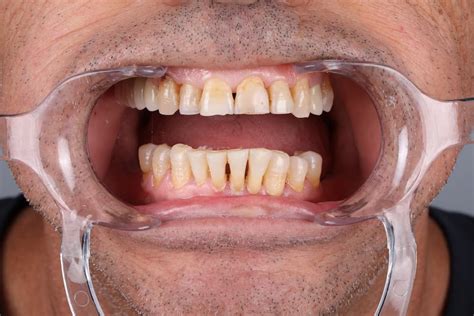 Sore Gums: Symptoms, Causes, and Treatments - Maltepe Dental Clinic