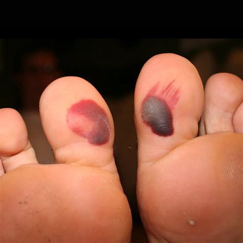 Blood Blister On Foot - Do's and Don'ts - Blister Prevention