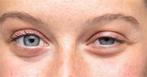 Botox Side Effects Droopy Eyelid