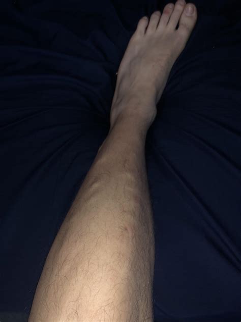 Bumps on my legs under skin : r/medical_advice