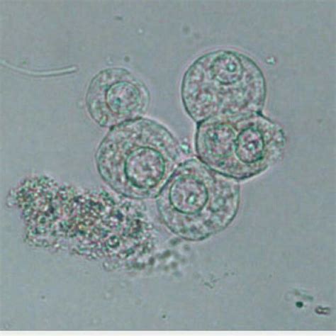 Renal tubular epithelial cells | Medical technology, Urinal, Medical laboratory science