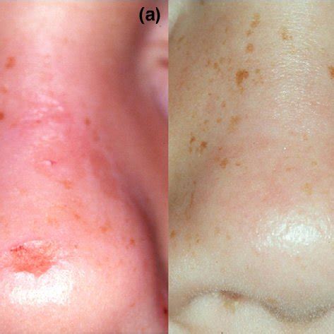 Clinical features of pseudoporphyria. (a) Crusted erosion on the tip of... | Download Scientific ...