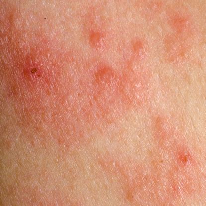 Pityriasis Rosea Stages, Symptoms and Complications