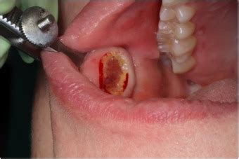 Use of a chalazion clamp for intraoral biopsies: a technical note - British Journal of Oral and ...