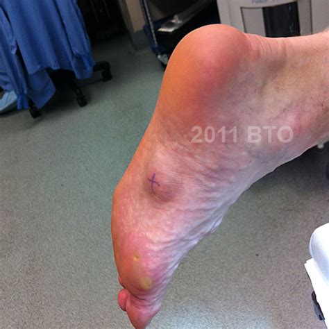 Plantar fibroma - Foot and AnklePlantar fibroma - Foot and Ankle ...