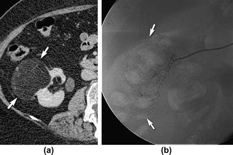 Embolization of renal angiomyolipoma: immediate complications and long-term outcomes - Clinical ...