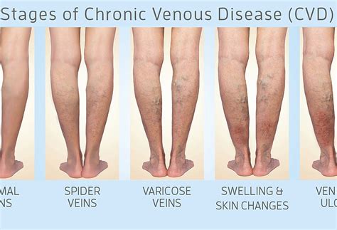 Sponsored: Stages of Vein Disease: What Stage Am I? | Your Observer