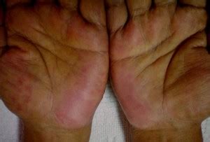 Palmar Erythema - Pictures, Symptoms, Causes, Treatment