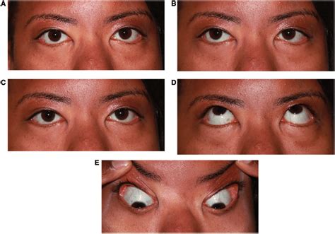 Pattern 1. Bilateral horizontal gaze palsy. (A) Central position with ...