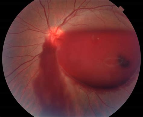 Vitreous Hemorrhage - Retina Eya Care, P.C.