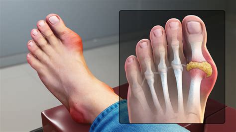 Causes Of Gout Big Toe