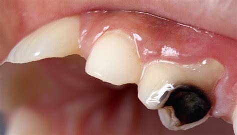 Managing High-Risk Patients With SDF - Dimensions of Dental Hygiene