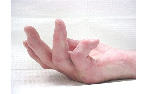 The 'Most Common Crippling Hand Condition' You've Never Heard Of - Dupuytren Research Group