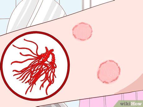 How to Prevent Skin Fungus (with Pictures) - wikiHow