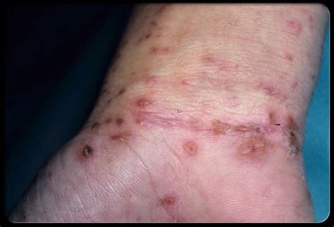 11 best Scabies Mite Infestation images on Pinterest | Remedies, Bugs and Insects