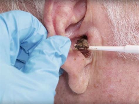 Earwax Removal: Best and Safest Practices