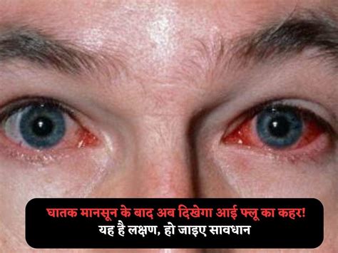 Eye Flu: घातक मानसून के बाद अब दिखेगा आई फ्लू का कहर! यह है लक्षण, हो ...