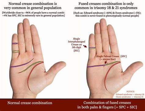 Pin on Simian line / simian crease / single transverse crease