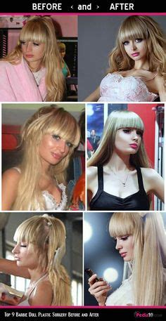 22 Barbie Doll Surgery Before and After ideas in 2022 | surgery, lip surgery, barbie