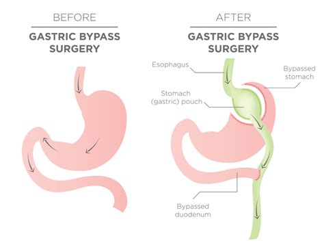 Can you have gastric bypass twice? Learn more with Bari Life Blogs