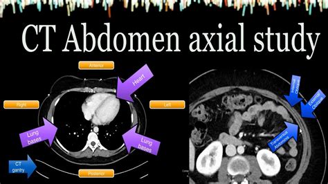 ct abdomen axial view study - YouTube