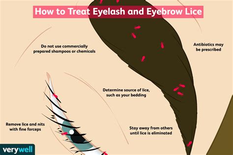 Treating Lice in Eyebrows and Lashes