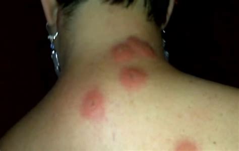 Bed Bug Bites – Pictures, Symptoms, Causes, Treatment | HubPages