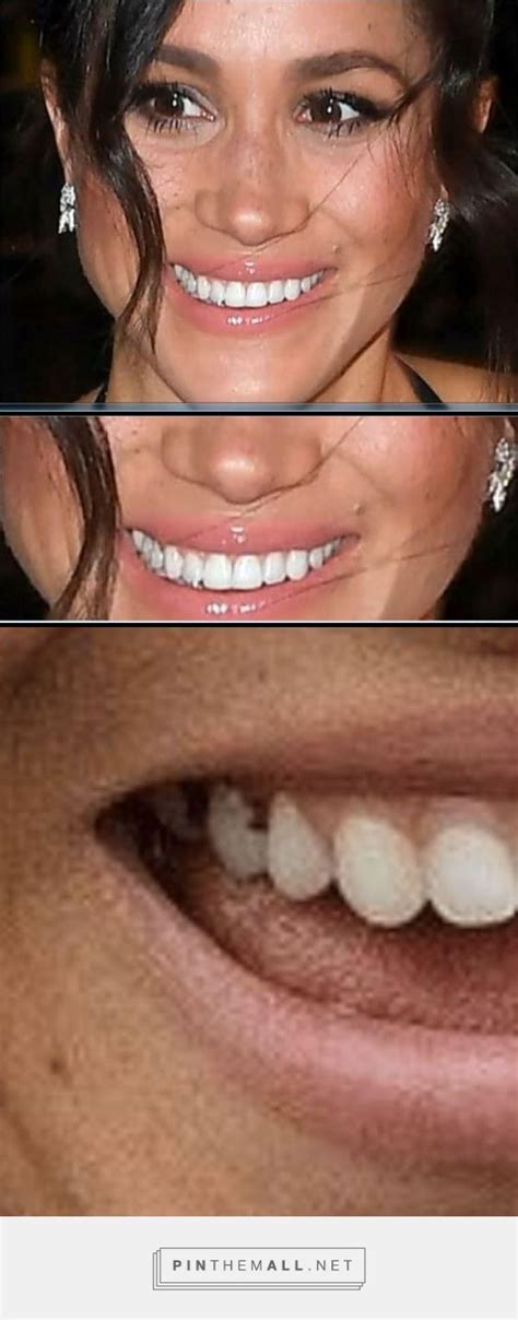 Meghan Markle;s back teeth have the same problem. She covers up her upper and lower front teeth ...