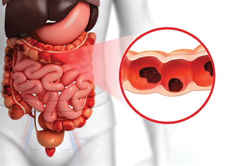 ABDOMINAL TUBERCULOSIS: DIAGNOSIS AND TREATMENT