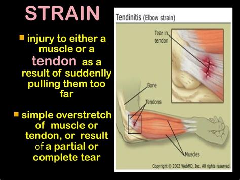 Strain sprain fracture