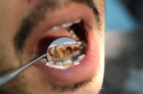 Will Vaping Stain Your Teeth? | Sunshine Dental | Calgary