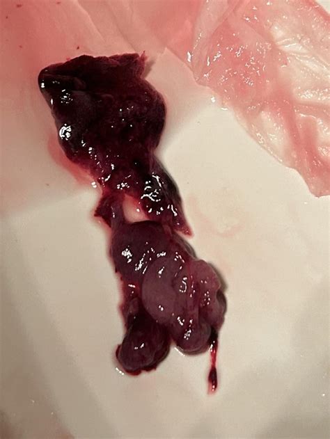 IM ON MY PERIOD. IS THIS MISCARRIAGE OR BLOOD CLOT : r/Periods