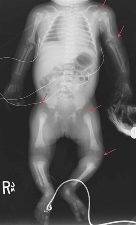 Rhizomelic chondrodysplasia punctata causes, symptoms, diagnosis, treatment & life expectancy