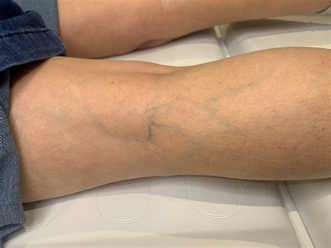 Reticular Veins In Legs